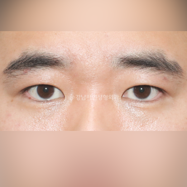 절개눈매교정 AFTER