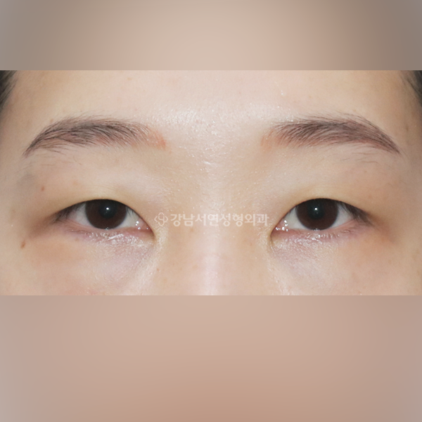 매몰쌍꺼풀+뒤트임+밑트임 BEFORE
