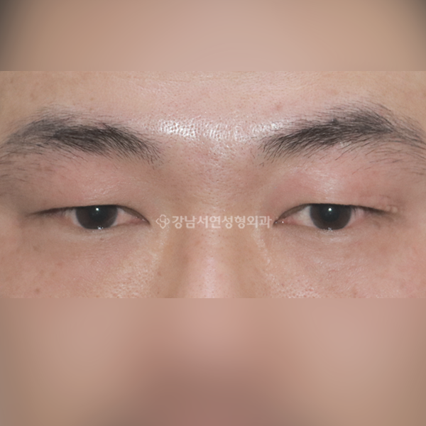 절개눈매교정 BEFORE