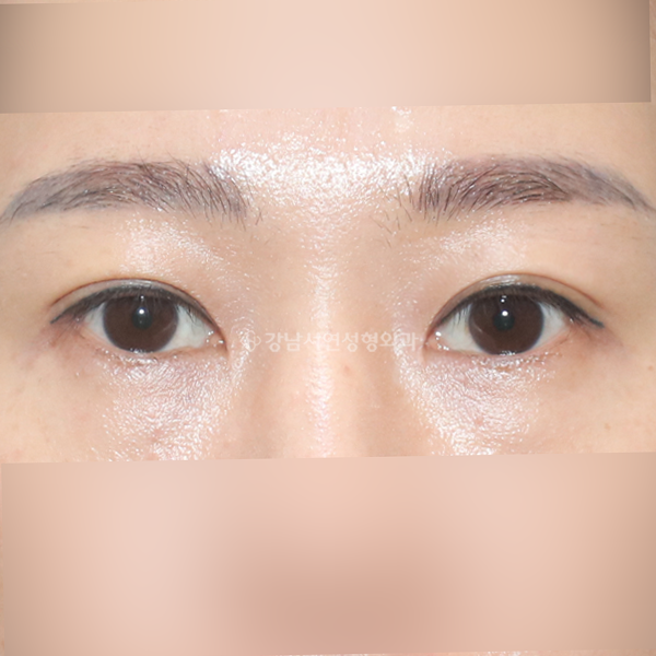 상안검+앞트임 AFTER