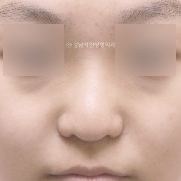여자코성형 BEFORE