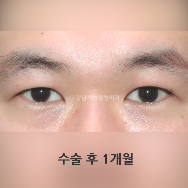 남자 무쌍눈매교정 AFTER