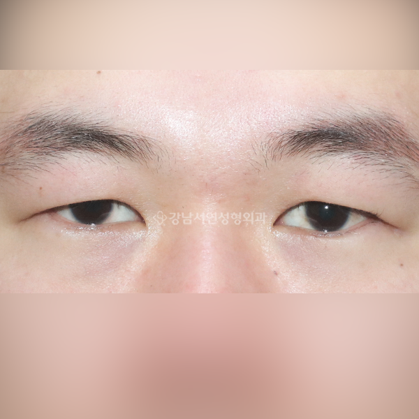남자 무쌍눈매교정 BEFORE