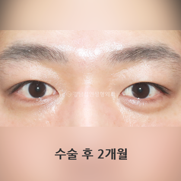 남자 쌍꺼풀 없애기 AFTER