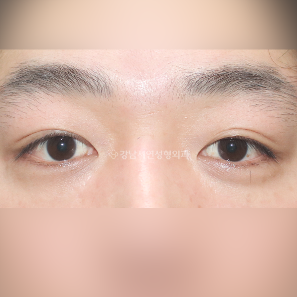 남자 쌍꺼풀 없애기 BEFORE