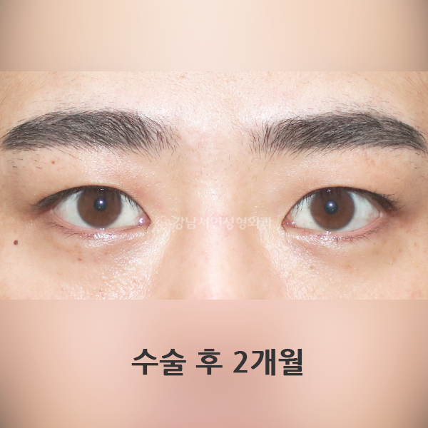쌍꺼풀 없애기 AFTER