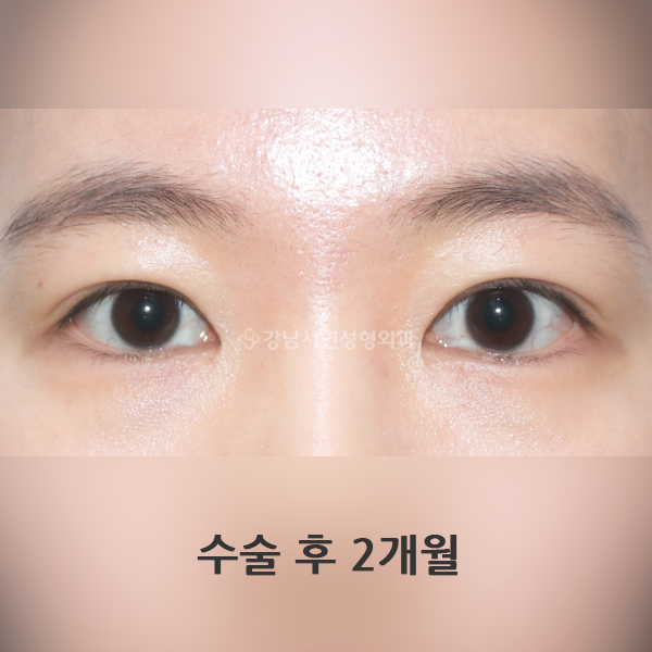 절개쌍꺼풀 재수술+짝눈교정 AFTER