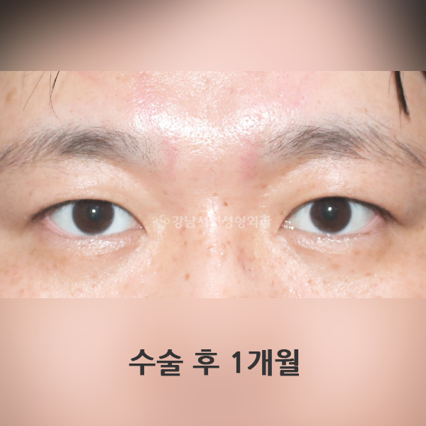절개눈매교정 AFTER