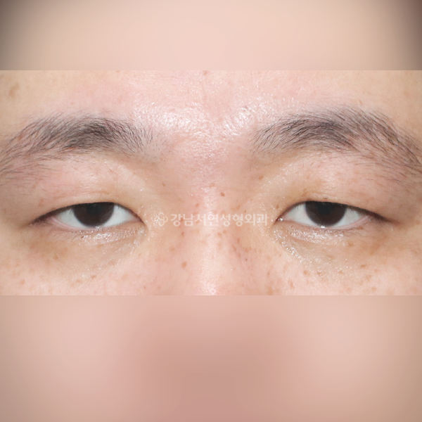 절개눈매교정 BEFORE