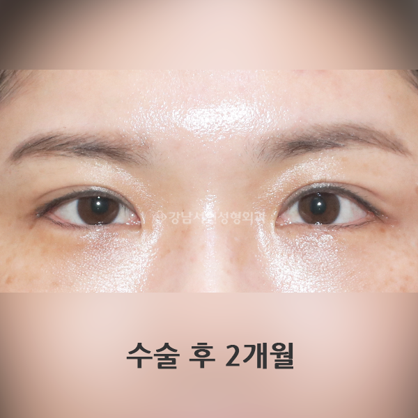 쌍꺼풀 재수술+뒤밑트임 AFTER