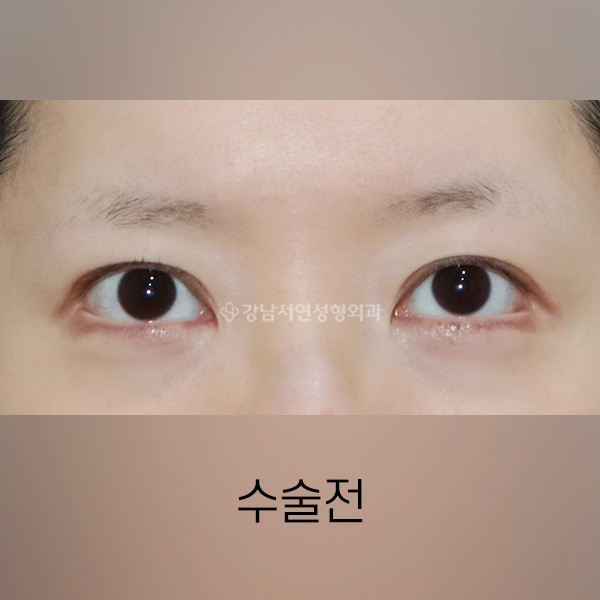 뒤트임 복원 BEFORE