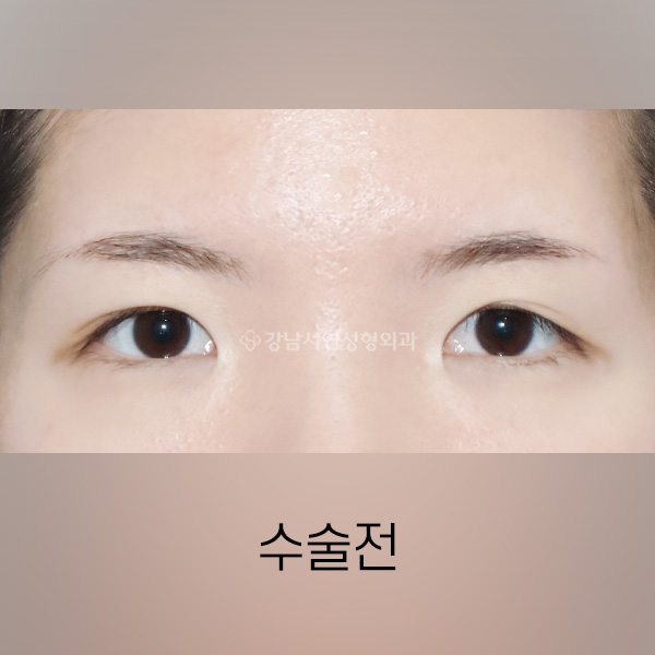 쌍꺼풀 풀림 교정 BEFORE