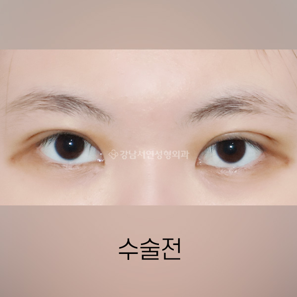 절개눈매교정 BEFORE
