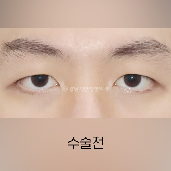 남자 절개쌍꺼풀 BEFORE