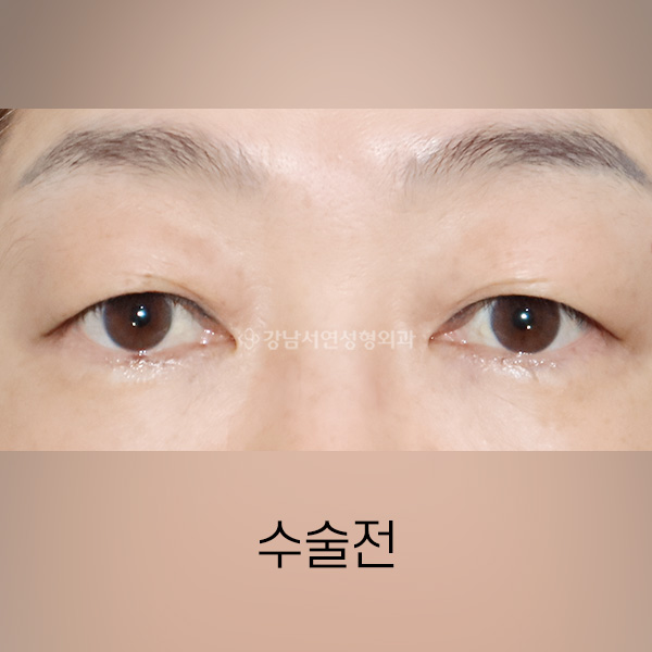 상안검 BEFORE