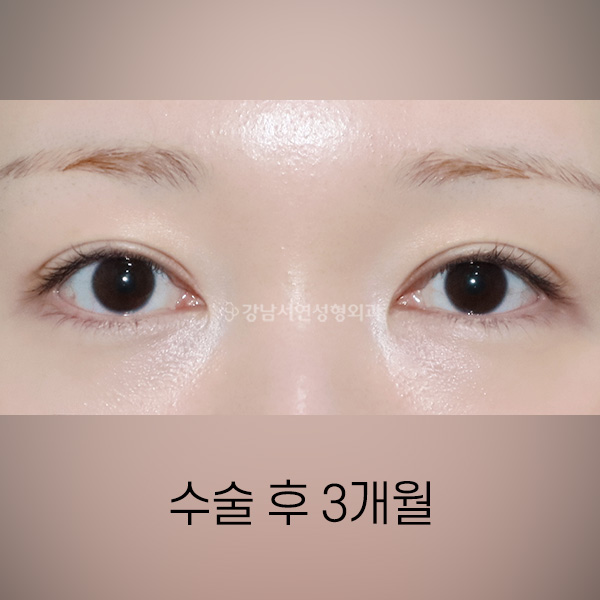 절개쌍꺼풀 재수술 AFTER
