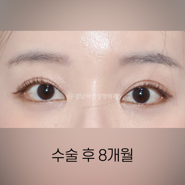 절개쌍꺼풀 재수술 AFTER