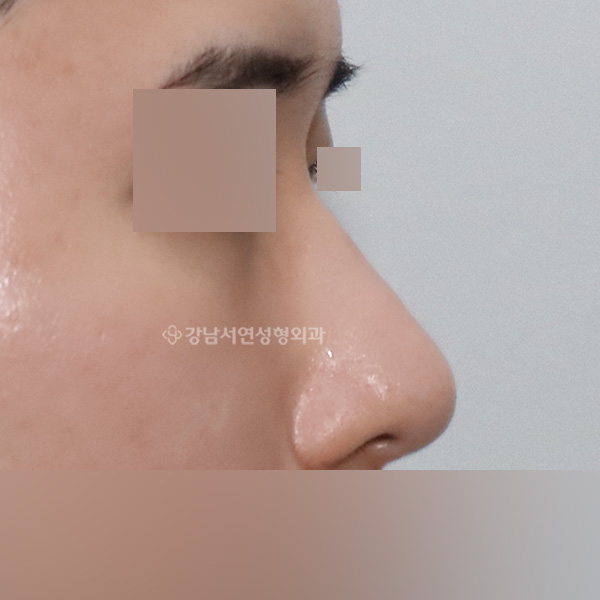 무보형물 코성형 측면 AFTER