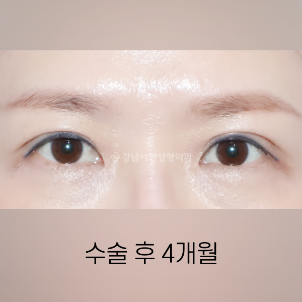 절개쌍꺼풀 재수술 AFTER