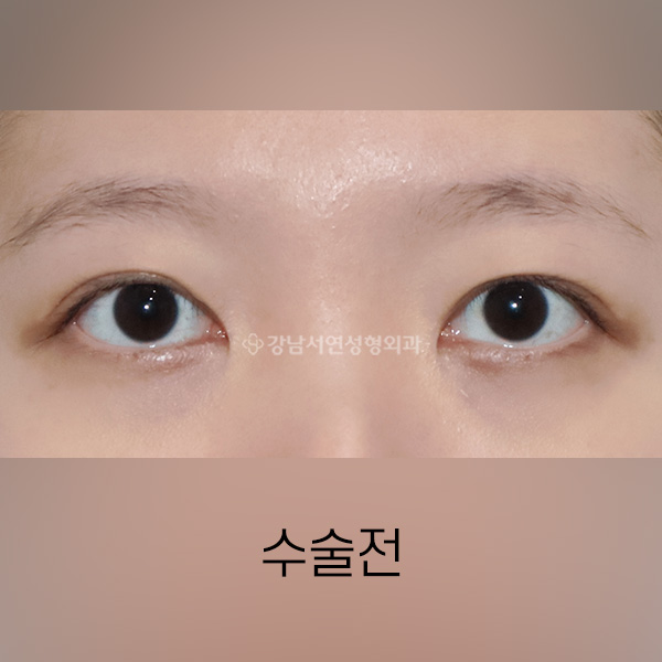 라인높이는 두줄따기 BEFORE