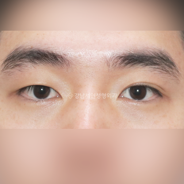 쌍꺼풀 없애기 BEFORE