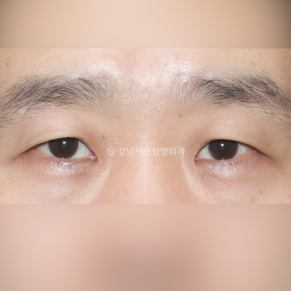 남자눈매교정 BEFORE