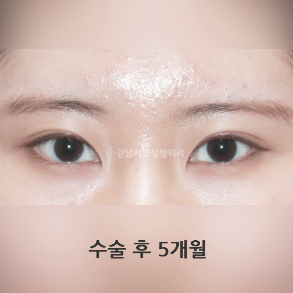 두줄따기 라인 낮추기 AFTER