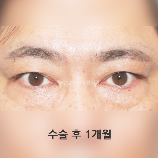 쌍꺼풀 없애기(낮추기) AFTER