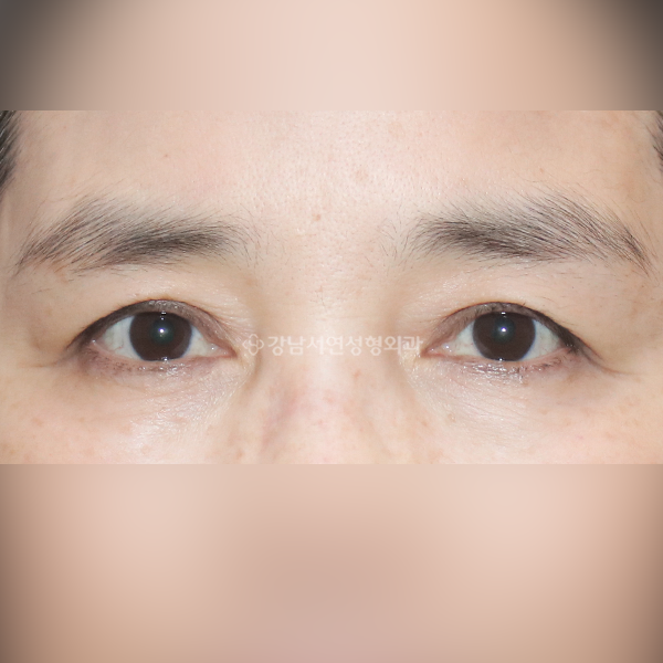 눈썹하거상 BEFORE
