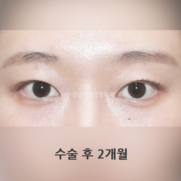 라인 낮추기 AFTER