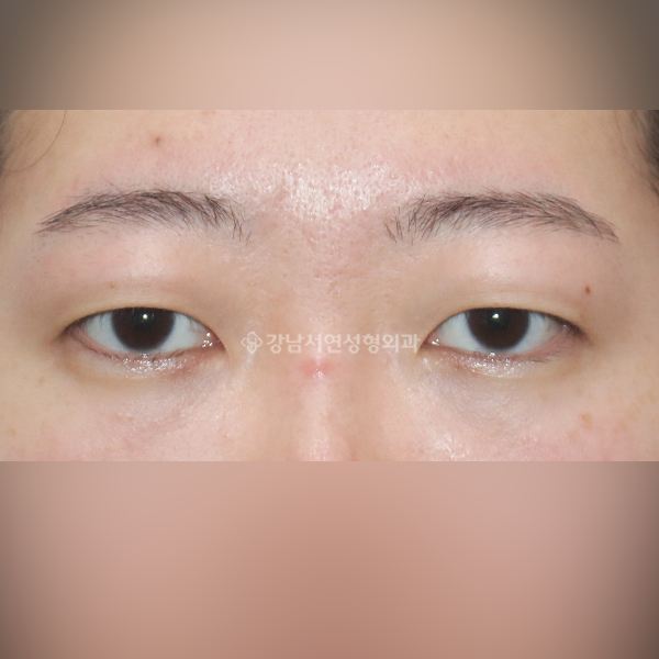 상안검 BEFORE