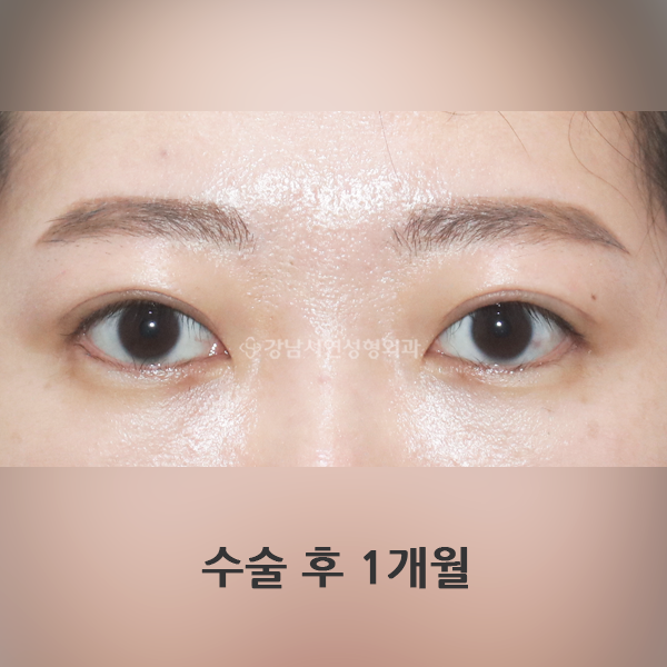 상안검 AFTER