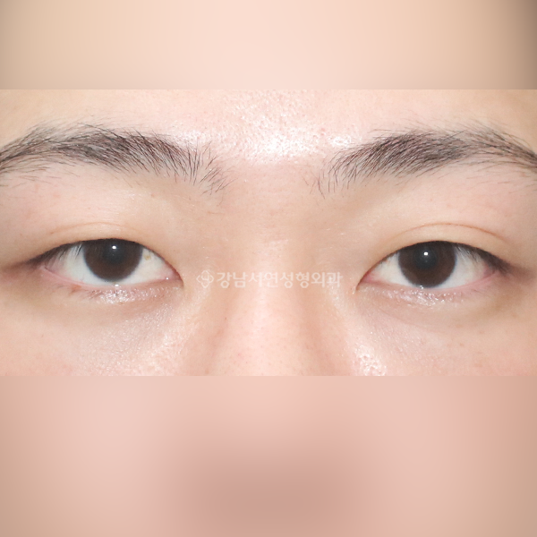 남자 쌍꺼풀 없애기 BEFORE