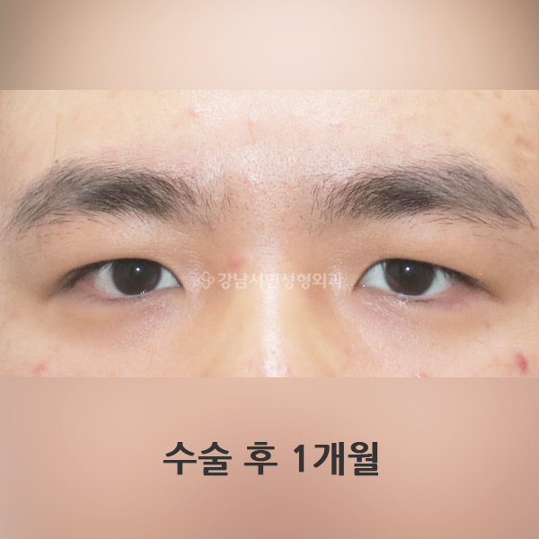 남자 (무쌍)속쌍꺼풀 AFTER