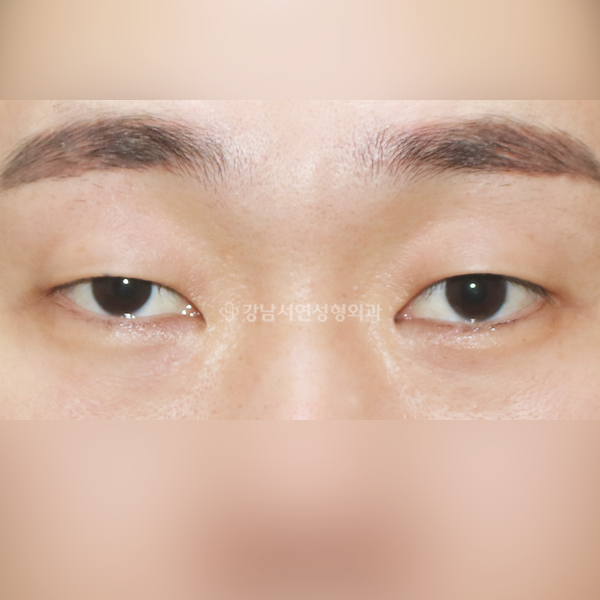남자 무쌍눈매교정 BEFORE