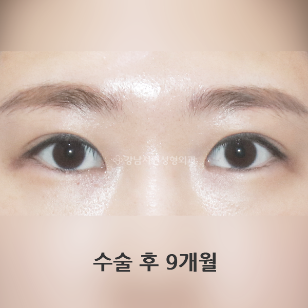 절개 쌍꺼풀 AFTER