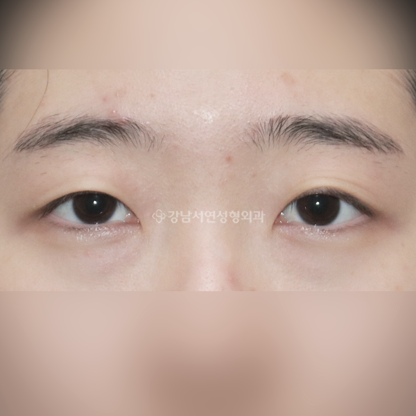 절개눈매교정 BEFORE