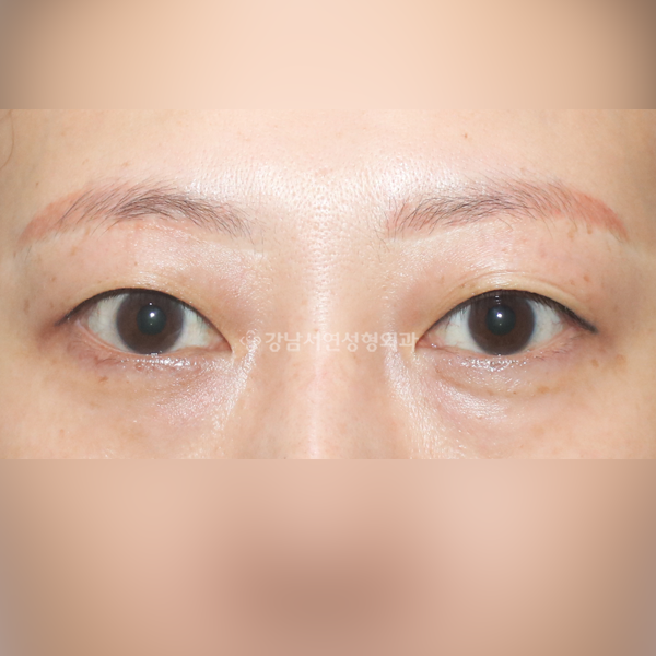 상안검 BEFORE