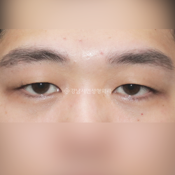 남자 무쌍(속쌍)눈매교정 BEFORE