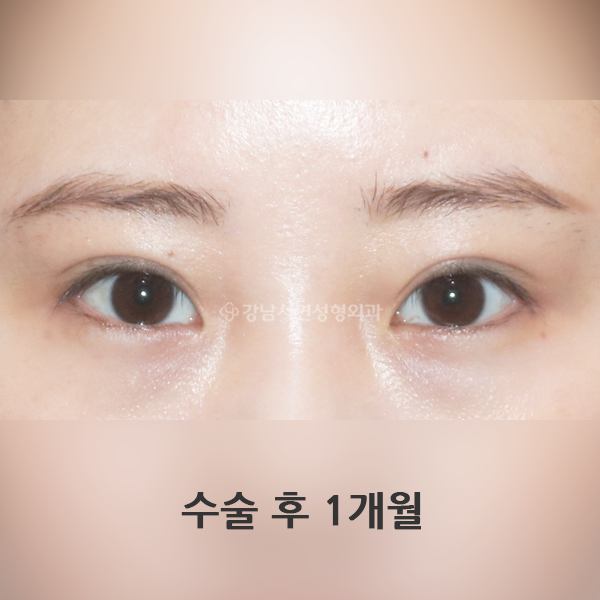 짝눈 교정 재수술(라인 변경) AFTER