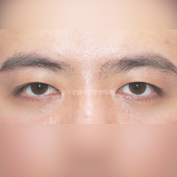 절개 쌍꺼풀 재수술(두줄따기) AFTER