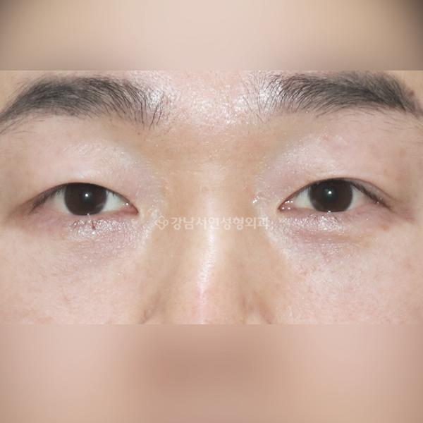 눈밑지방재배치 AFTER