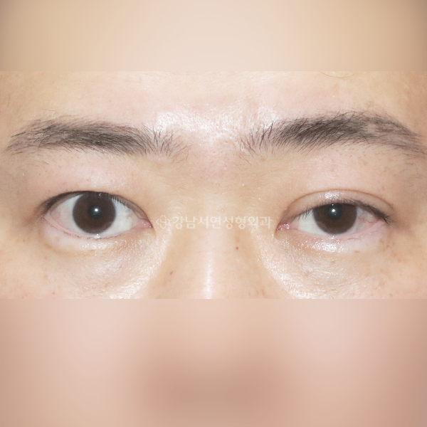 짝눈 교정 BEFORE