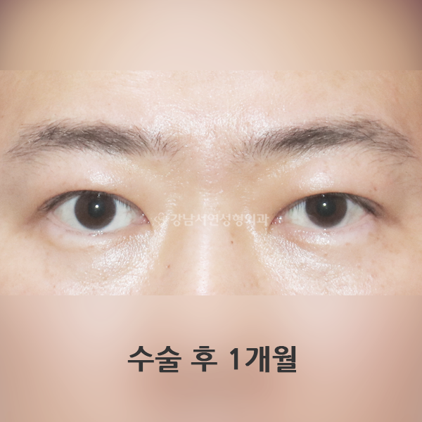 짝눈 교정 AFTER