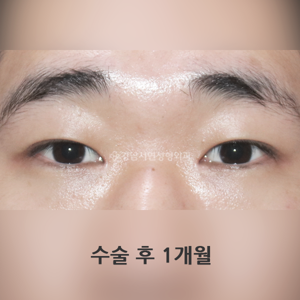 남자 무쌍(속쌍)눈매교정 + 앞트임 AFTER