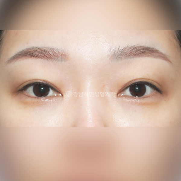 쌍꺼풀 풀림 재수술 BEFORE