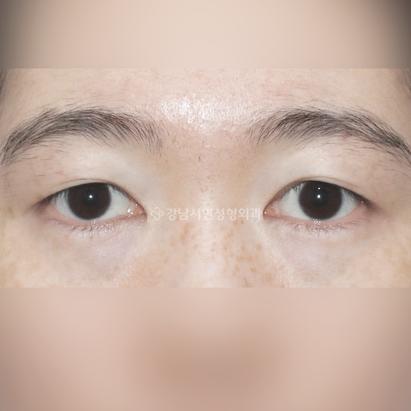 절개 쌍꺼풀 재수술 BEFORE
