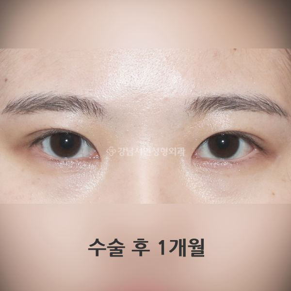 매몰쌍꺼풀+앞트임 AFTER