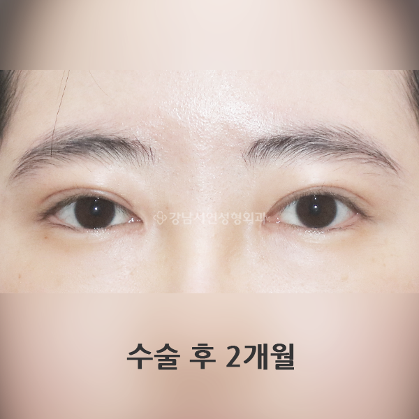 절개쌍꺼풀+앞트임 AFTER