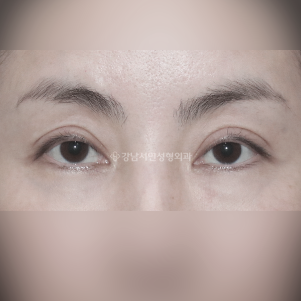 쌍꺼풀 재수술 라인 낮추기 BEFORE